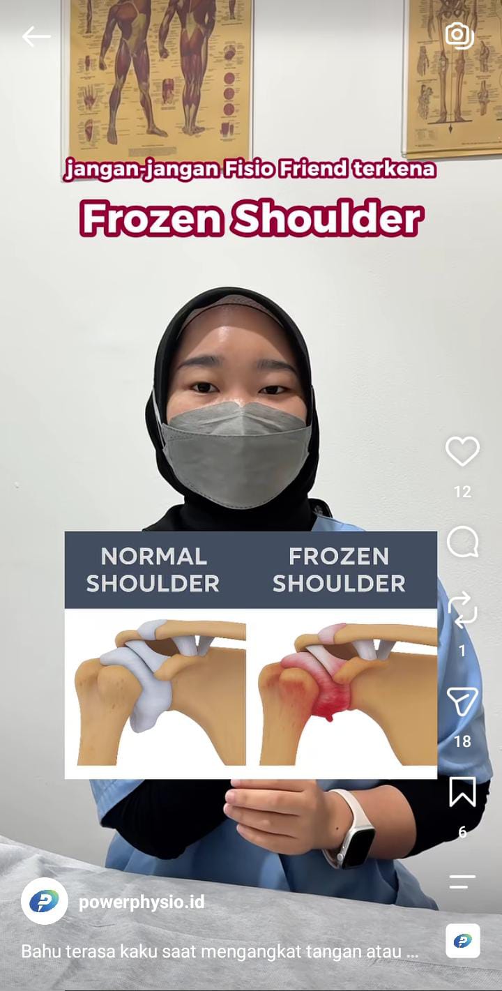 Frozen Shoulder
