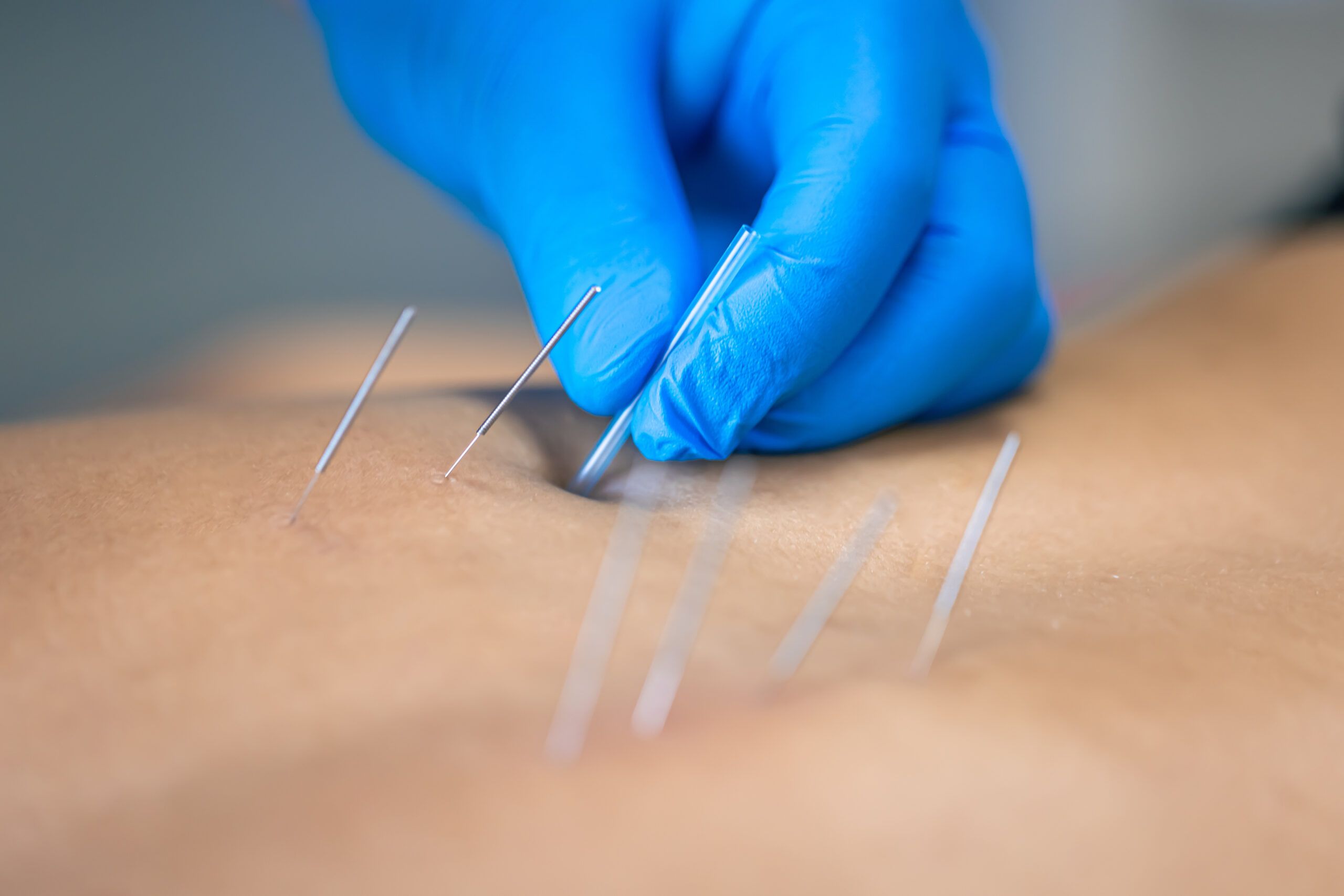 Sesi terapi Dry Needling di Power Physio